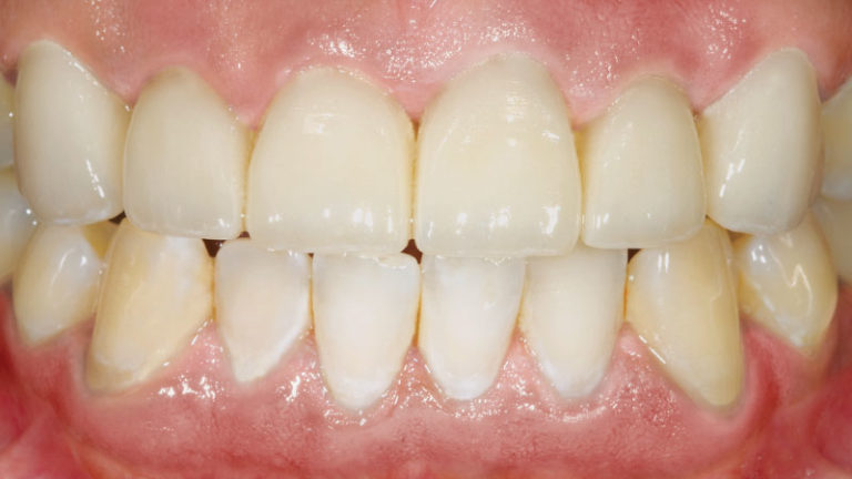 Una vez finalizados los procedimientos endodónticos de post y núcleo, los dientes #6, #7 y #9 comenzaron a oscurecerse. IPS e.max oculta los tonos oscuros de los muñones.